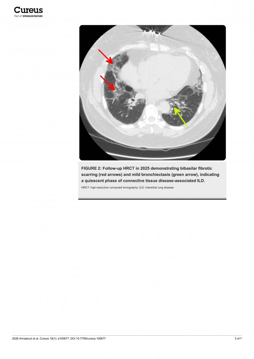 Follow-up HRCT demonstrating bibasilar fibrotic scarring and mild bronchiectasis, indicating a quiescent phase of connective tissue disease-associated ILD.