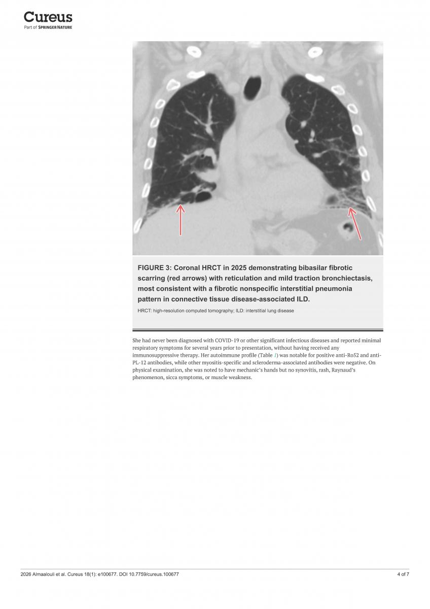Coronal HRCT demonstrating bibasilar fibrotic scarring with reticulation and mild traction bronchiectasis, most consistent with a fibrotic nonspecific interstitial pneumonia pattern in connective tissue disease-associated ILD.
