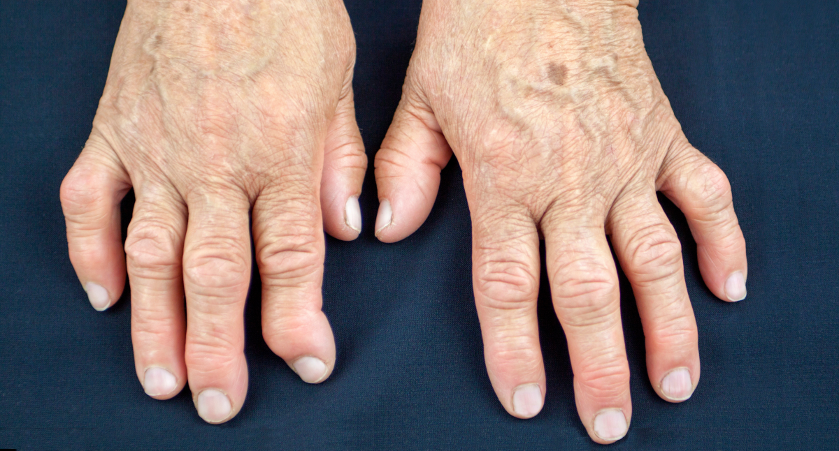 Rheumatoid arthritis of the hands