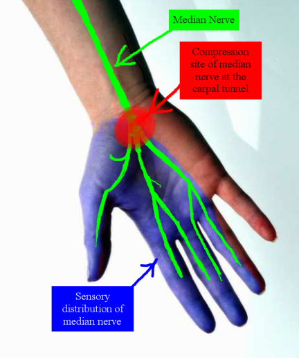 The median nerve provides feeling and movement to the "thumb side" of the hand (the palm, thumb, index finger, middle finger, and thumb side of the ring finger).